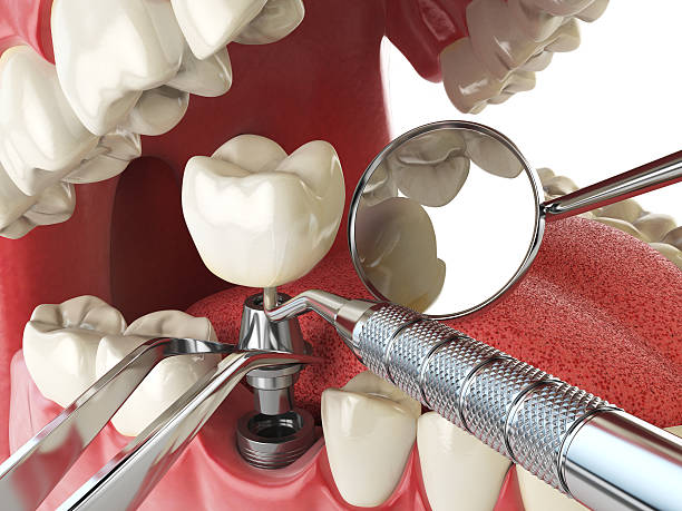 Best Emergency Treatment for Dental Infections or Abscesses in Palos Verdes Estates, CA